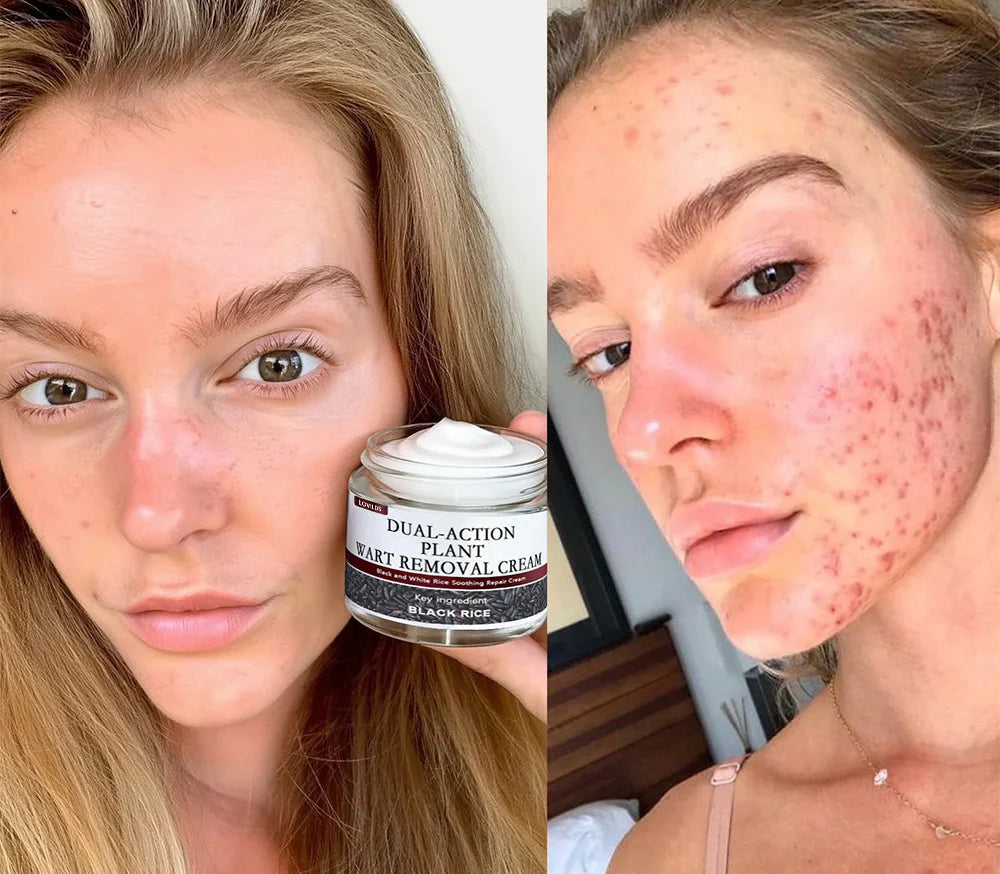 🔥First 100 :2nd ltem 60% Off🔥LOVILDS™ Black Rice Skin Repair Cream – Clinically Tested Wart & Skin Tag Remover